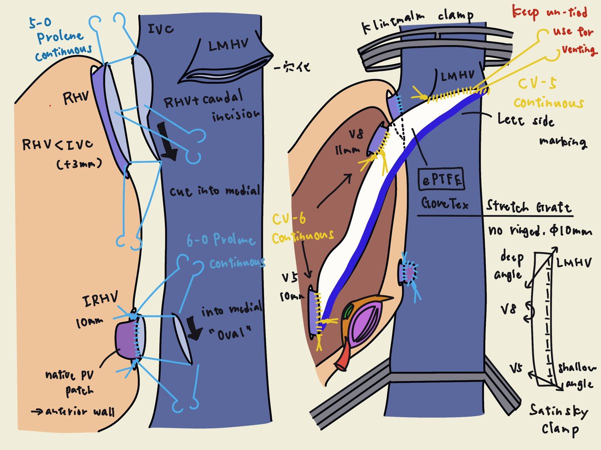 LDLT technique

ePTFE reconstruction as Neo-MHV for V5 and V8. Needed to adjust length between each branch and to put small pitch suture.