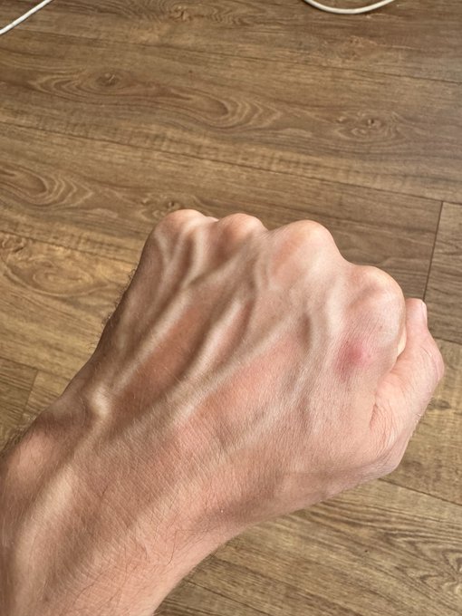 we back (mosquito bite and all) https://t.co/YNV43OxAD2