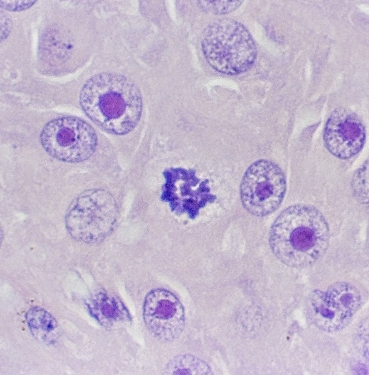 MBBS_Pathology's tweet image. #Prophase 
#melanoma 
#pathology 
#dermatology
👿😎