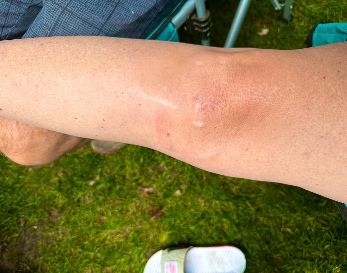 DuchessOfMeme's tweet image. Blasted the top of my mf shin, off the bed in the camper. That whole area is numb from nerve damage but boyyyyyyy am I feeling it #motrin #kneeproblems #midlifecrisis #alcohol 🤣🤣🤣