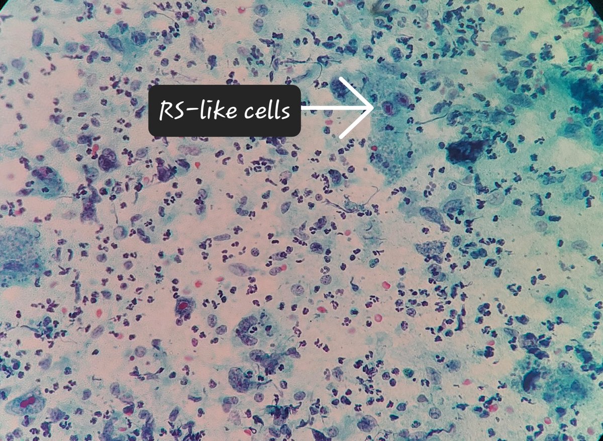 padmapathology1's tweet photo. An example of Touton giant cells, emperipolesis and RS-like cells with emperipolesis
#BSTpath
#pathology
#pathresidents #pathbasics https://t.co/L4k4Zz3hOy