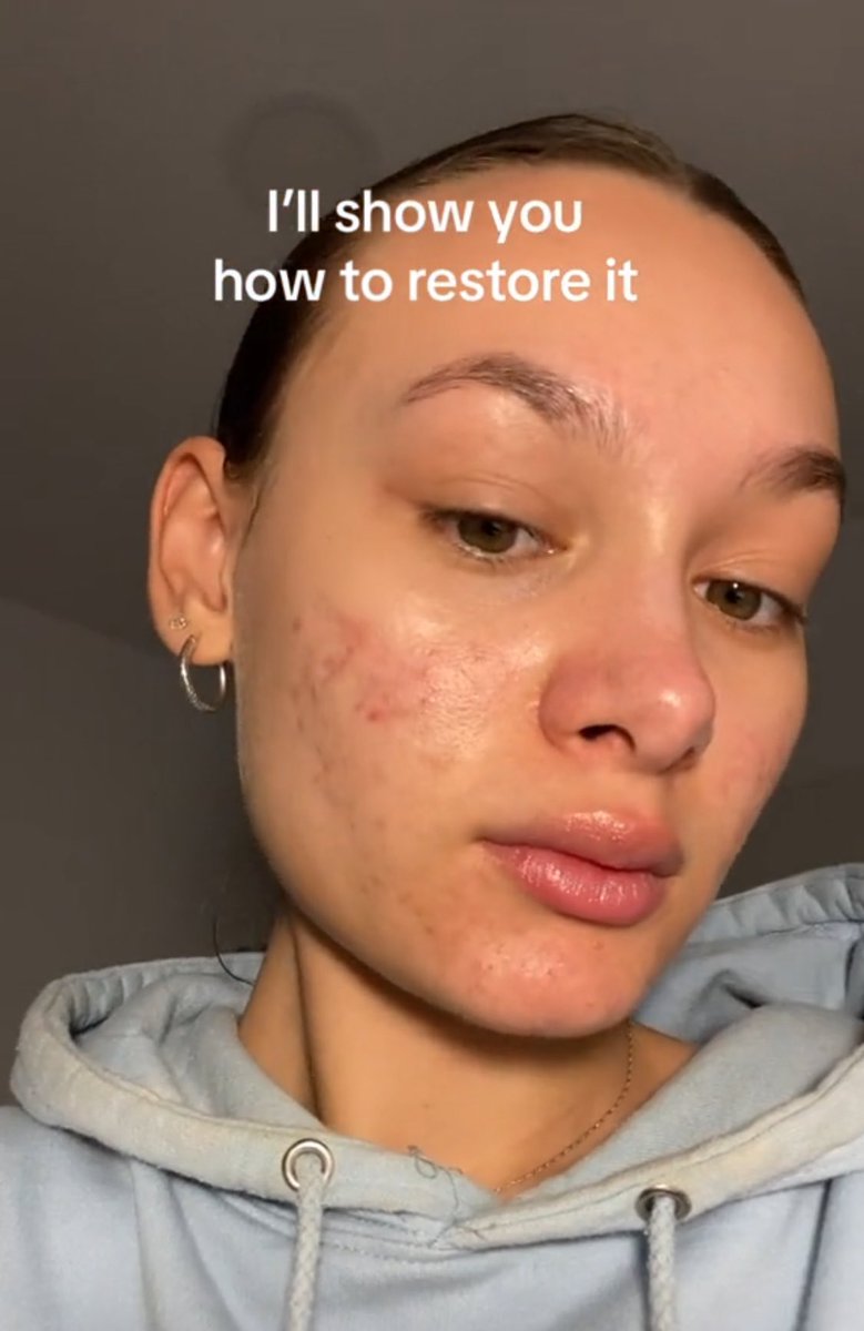 Kalau kulit non stop keluar jerawat apa pun repair skin barrier dulu. But make sure use the right product, be patient and consistency is the key☝🏻