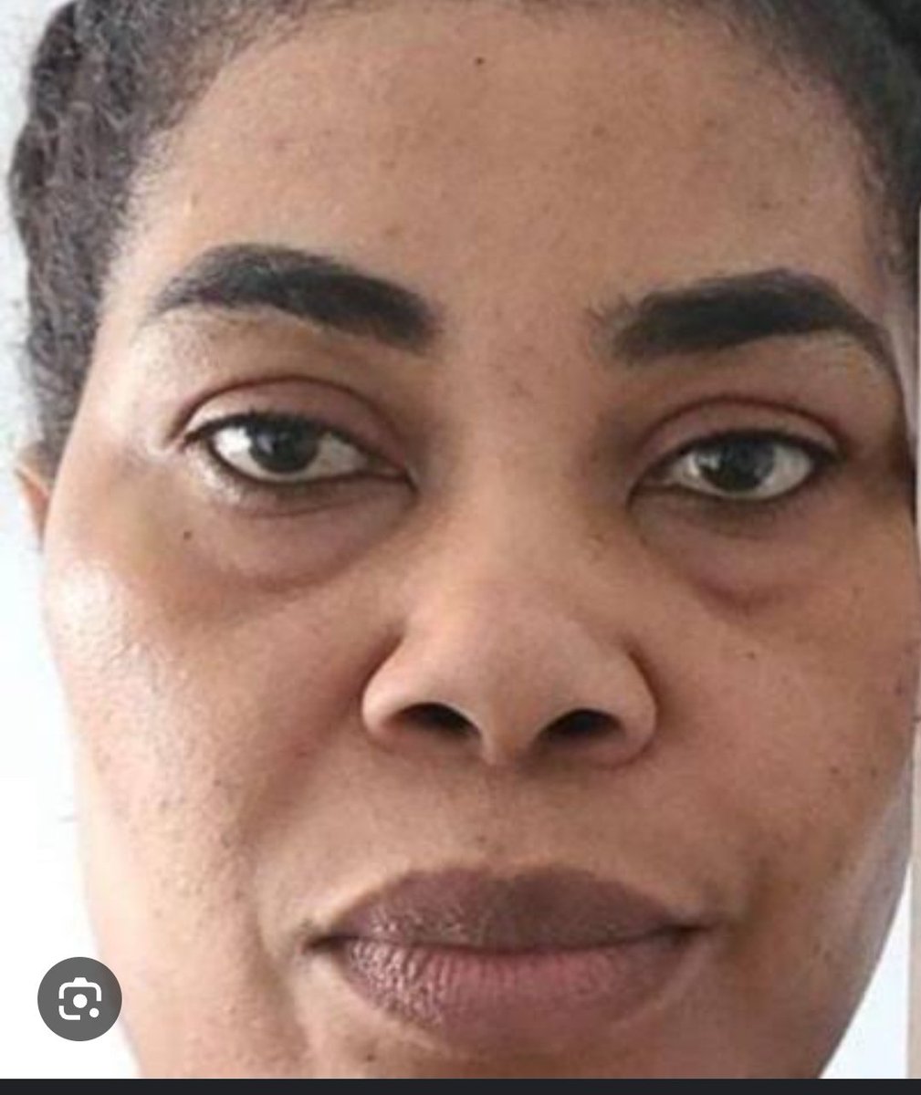 MalcolmInfiniti's tweet photo. AUNTY DABIRI EREWA  ,CHARITY  BEGINS AT HOME .. BY CHIEF MALCOLM  EMOKINIOVO OMIRHOBO .
Aunty Dabiri-Erewa while   pursuing justice in the case of  Amaka Patience  Sunnberger’s threat to poison Yoruba and Bini people in  far away Canada., please tell us the scores back home in Nigeria of those who threatened to kill the Igbos . If you fail to do so , I will take it to mean that  you are hypocritical  and an apostle  of selective justice . 
In fact ,  Aunty   Dabiti , if you cannot reveal the identities of those in Nigeria who are behind the threat to kill their fellow  compatriot s within 48 hours from the publication  of this post and press for their prosecution with the same energy that you are putting in the Amaka-s  ,  I advise you  to keep quiet and stop grandstanding  so that the  Canadian authorities can  handle the case without  on level a  ground.  They are more than capable  to do justice to the case  and do not need inputs from a biased  bigot  and hypocrite like you  .

Aunty Dabiri , stop wasting our  scarce  resources to catch cruise, charity begins at home .
..
