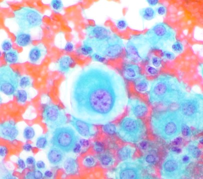 CC337. What a cytoplasm! I can't take my eyes off.
Day 0: pleural effusion in a middle aged woman. The chest X ray shows a "balloon release" or cannonball pattern. 
"It is positive. If you know anything else that can help me let me know". Two hours later the phone rang. #cytopath