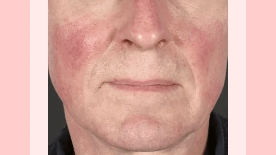The Importance of Modality – Acne Rosacea Treated with Rhus Venatum – Hpathy.com buff.ly/4cw4rLd
