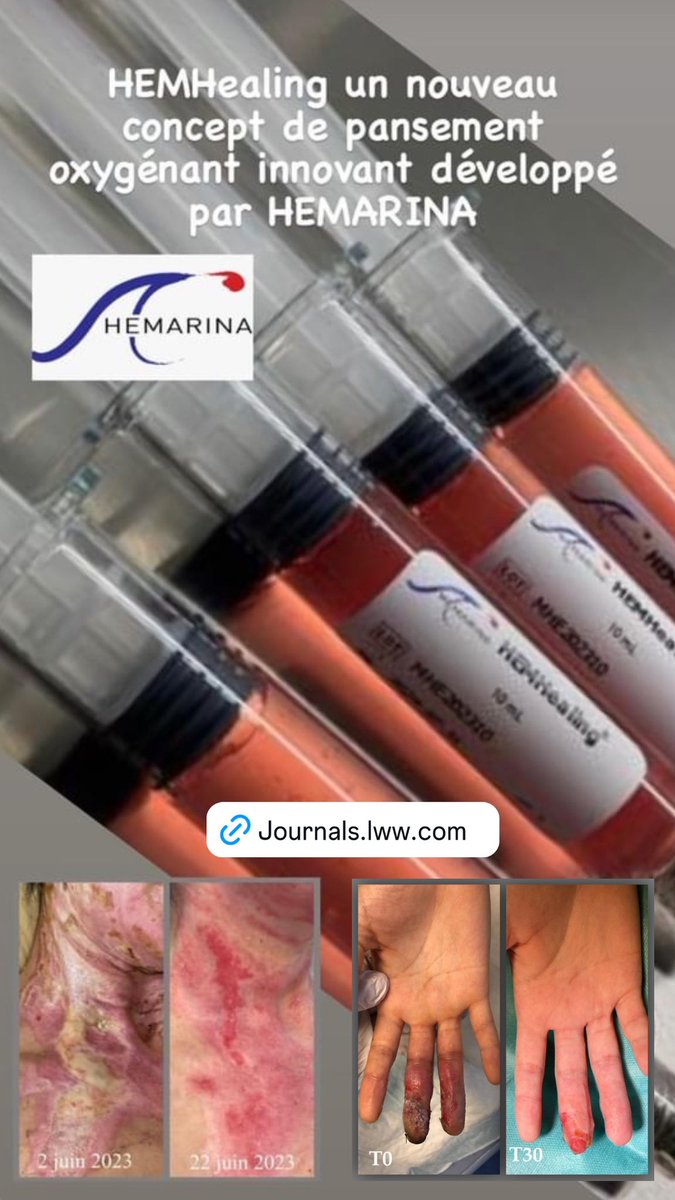 HEMHealing est un nouveau concept de pansement oxygénant conçu à partir de notre plate-forme technologique <a href="/Hemarina/">Hemarina</a> issue de 450 millions d’année d’évolution ou de R&amp;D #océan #plaie #oxygène -  lire ce case report 👇journals.lww.com/prsgo/fulltext…