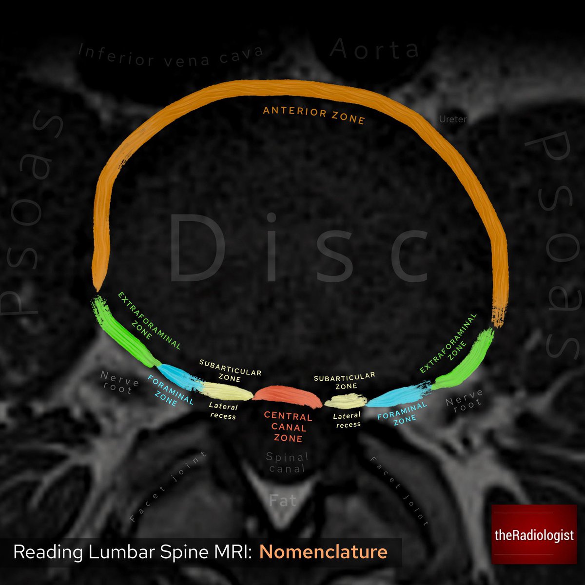 Reading Lumbar Spine MRI