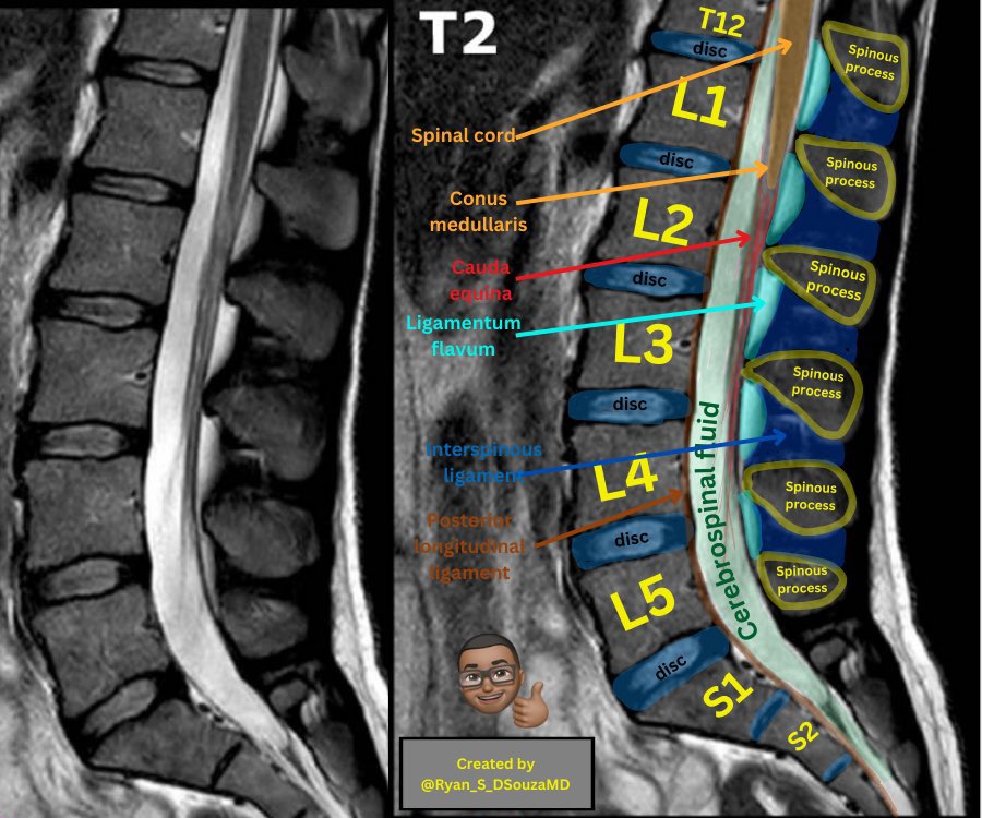 naif_h2's tweet photo. Reading Lumbar Spine MRI https://t.co/HelRQgER8y