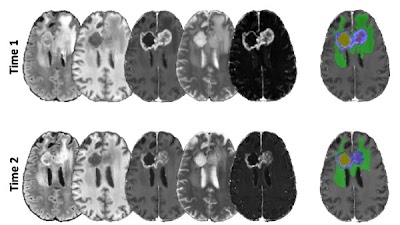 Radiology_AI's tweet photo. @UCSF ALPTDG is a publicly available #dataset of multimodal brain #MRIs from 298 patients with diffuse #glioma https://t.co/yYhfjXv10N @MeyerVillanueva @RadsUcsf @UCSF_Ci2 #NeuroRad #DataResources #AI https://t.co/Y0FO8SYmIL