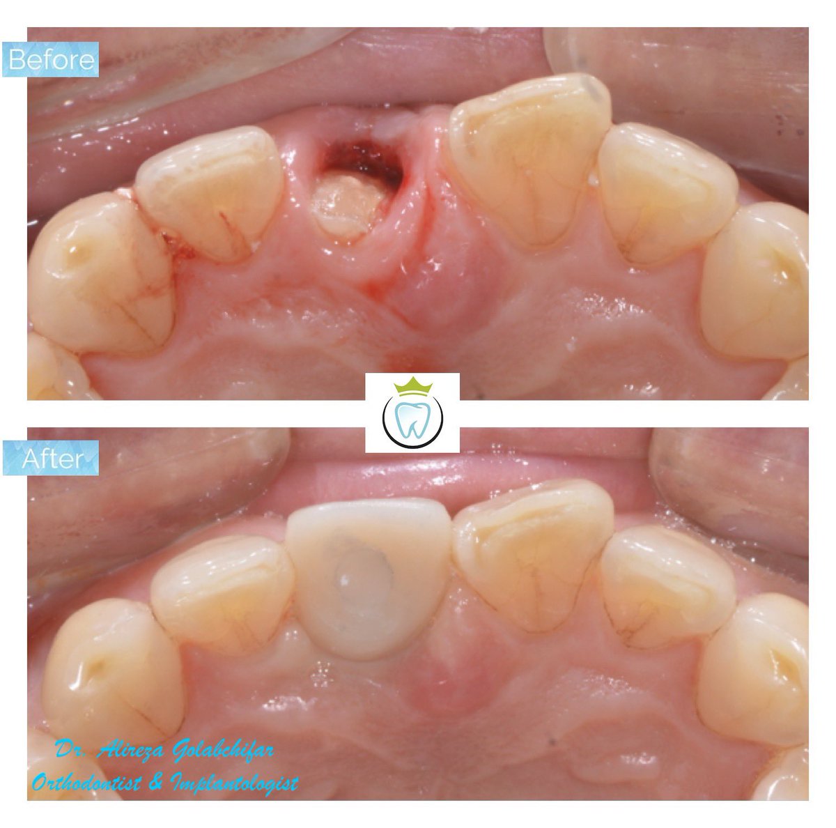 dentistry_king's tweet photo. Atraumatic extraction of tooth #11 with a gross crown fracture followed by immediate implant placement. In the office, CEREC CAD/CAM was used for making the final crowns.

#implant #immediateimplant #cosmeticdentistry #Straumann #empresswalkdental #kingwestdentistry https://t.co/YrAUbZI5eE