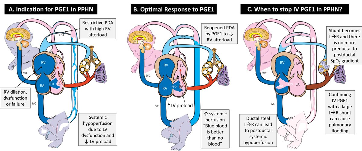 Satyan (@neosatyan) on Twitter photo Prostaglandin E1 in neonatal pulmonary hypertension: Need for randomized trials based on physiology - Mokha <a href="/UCDavisPedsRes/">UC Davis Pediatric Residency</a> - Pediatric Pulmonology - @Pedpulmonol <a href="/CardioNeo/">NeoCardioLab - Gabriel Altit</a> @amir_NHS <a href="/NeoHeartSociety/">Neonatal Heart Society</a> <a href="/NeoHemodynamics/">Neonatal Hemodynamics Research Centre</a> <a href="/AAPneonatal/">AAP Neonatal</a> onlinelibrary.wiley.com/doi/10.1002/pp… Prostaglandin E1 in neonatal pulmonary hypertension: Need for randomized trials based on physiology - Mokha <a href="/UCDavisPedsRes/">UC Davis Pediatric Residency</a> - Pediatric Pulmonology - @Pedpulmonol <a href="/CardioNeo/">NeoCardioLab - Gabriel Altit</a> @amir_NHS <a href="/NeoHeartSociety/">Neonatal Heart Society</a> <a href="/NeoHemodynamics/">Neonatal Hemodynamics Research Centre</a> <a href="/AAPneonatal/">AAP Neonatal</a> onlinelibrary.wiley.com/doi/10.1002/pp…