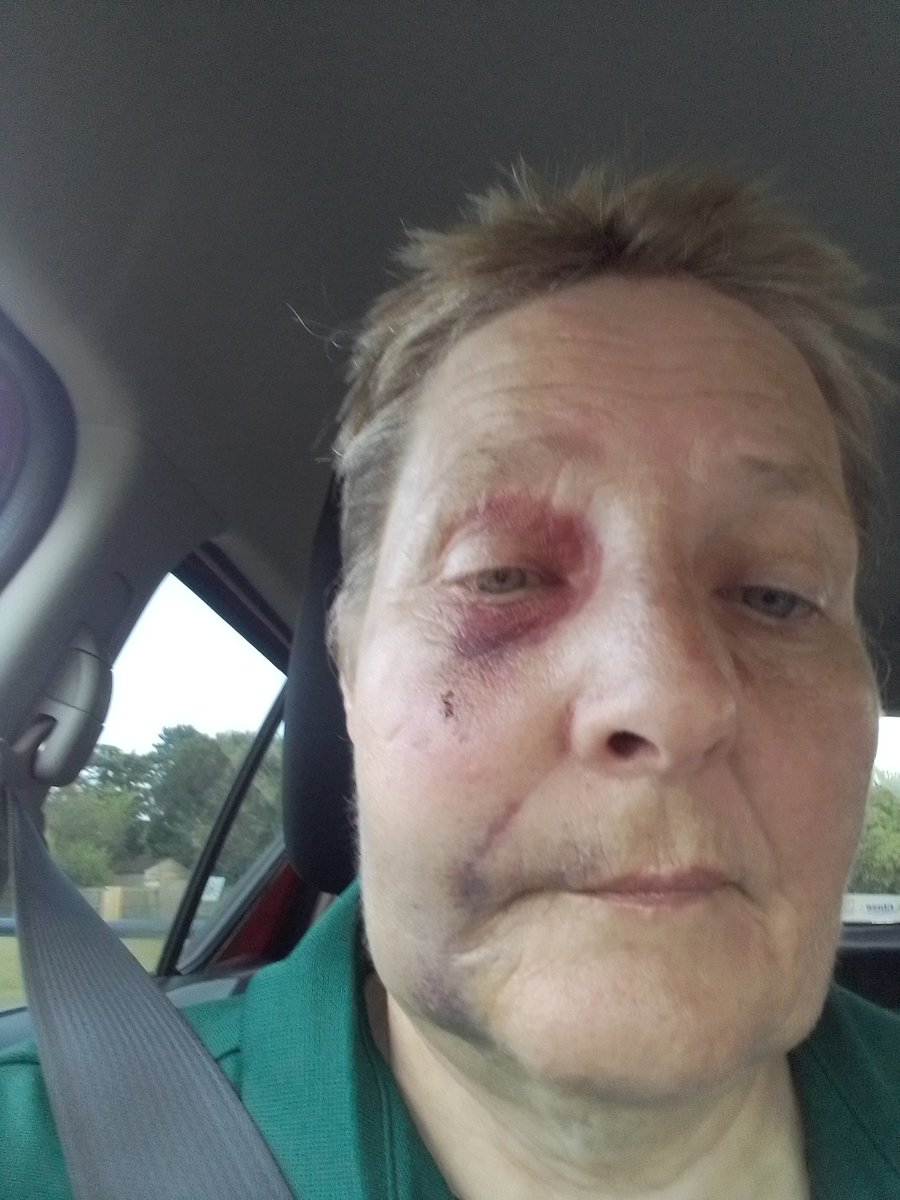 camket12's tweet photo. @JackRuleLD @a_y_harris @Sue_redfern 24 hours later after umpiring a 40 over game. Both eyes were working fine. https://t.co/2rXfqUYL3v