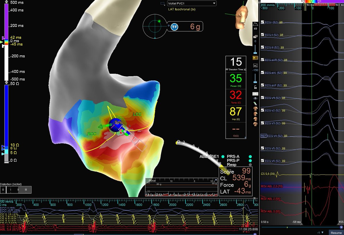 Kevin Brady (@hapa_ep) on Twitter photo -43 msec precocity and 99% pacematch at R-L ILT. 1 burn ❤️🔥 PVC elimination using retrograde approach and "shepherd's crook" prolapsed ablation catheter orientation from just below the valve. Case performed by <a href="/Maeskander/">Mike Eskander</a> -43 msec precocity and 99% pacematch at R-L ILT. 1 burn ❤️🔥 PVC elimination using retrograde approach and "shepherd's crook" prolapsed ablation catheter orientation from just below the valve. Case performed by <a href="/Maeskander/">Mike Eskander</a>