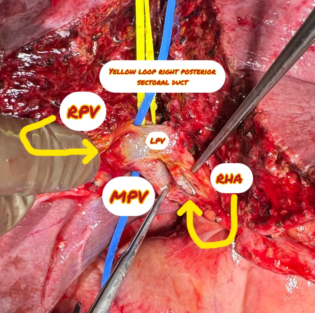 Difficult donor anatomy