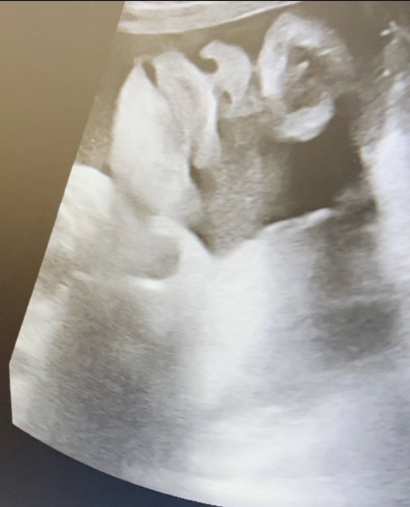BigBritishBardi's tweet image. Cardi shares ultra sound pic of baby “Hurricane”