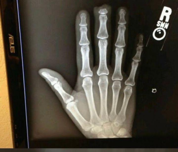 joni_kennedy's tweet photo. Day 1: Whoops... The time the dog bit my finger off #whoops #dogbite #365photochallenge #SeptemberPhotoChallenge  #PhotoOfTheDay #photochallenge #septemberchallenge #fall2024 #autumn  # #happylife #365photochallenge #photoadaychallenge2024 #SeptemberbreezesbringOctoberpumpkins https://t.co/CcgJvikjhJ