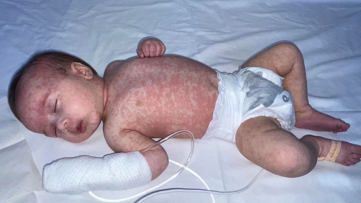 "I had no idea measles could make babies so ill"

@skynews share the story of baby Ezra from the #WestMidlands who caught #Measles at 3 months + was hospitalised

Our #ChildhoodImmunisation Campaign urges families to make sure their children are protected

bit.ly/SkyNewsStoryWM…