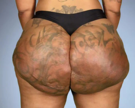 madebyrisch's tweet photo. This is the story of one of those woman whose dream of enhancing her figure turned into a nightmare. 
Read the full story here:  https://t.co/tTny2MRgNN

#madebyrisch #bellypaste #scars https://t.co/vEZ590DR32