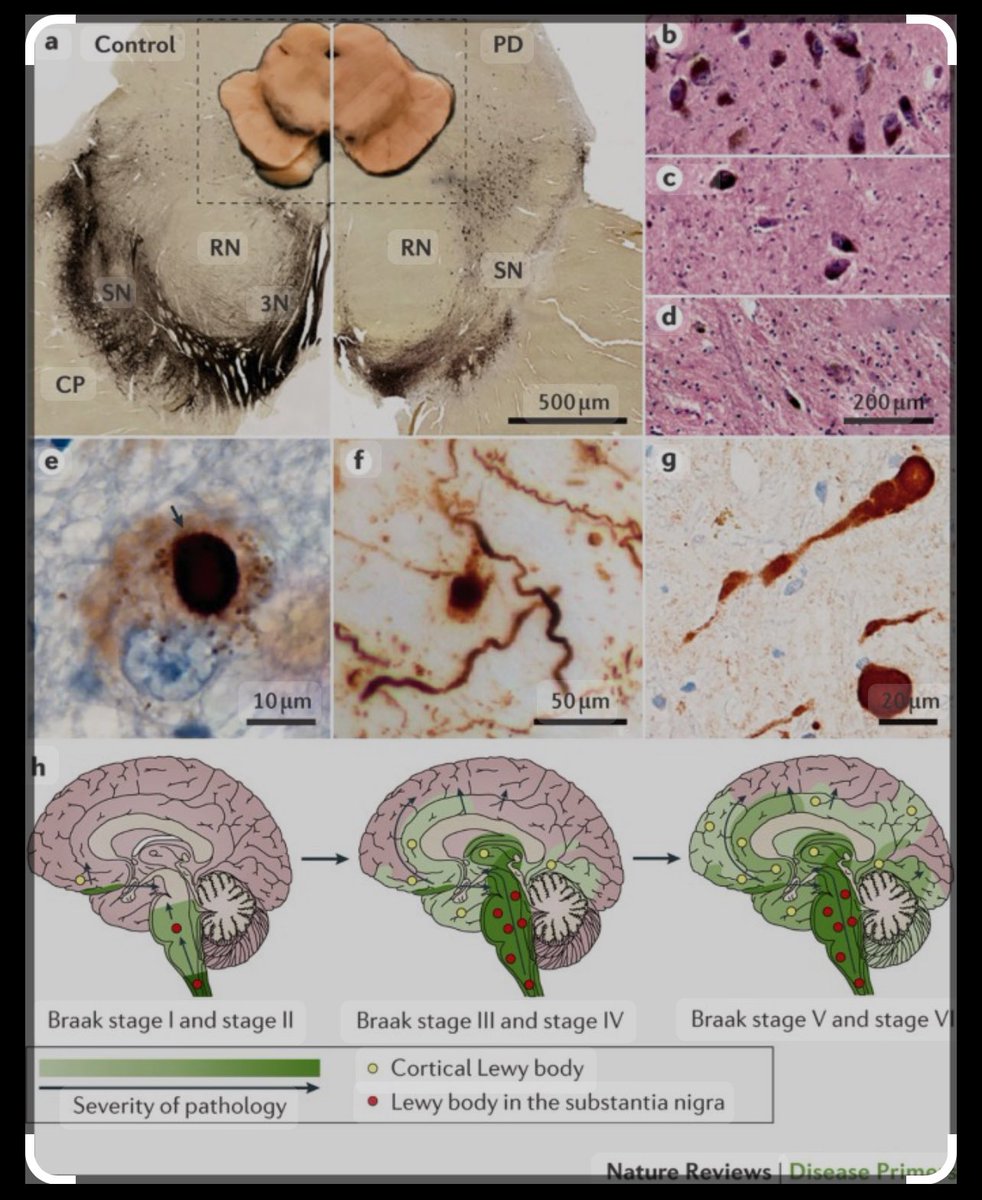 Whether you embrace Braak, Borghammer or not, this image from Poewe, Lang and others in <a href="/Nature/">nature</a> <a href="/DiseasePrimers/">Nature Reviews Disease Primers</a> 2017 is a single wonderful Parkinson teaching tool.
nature.com/articles/nrdp2… #parkinson
