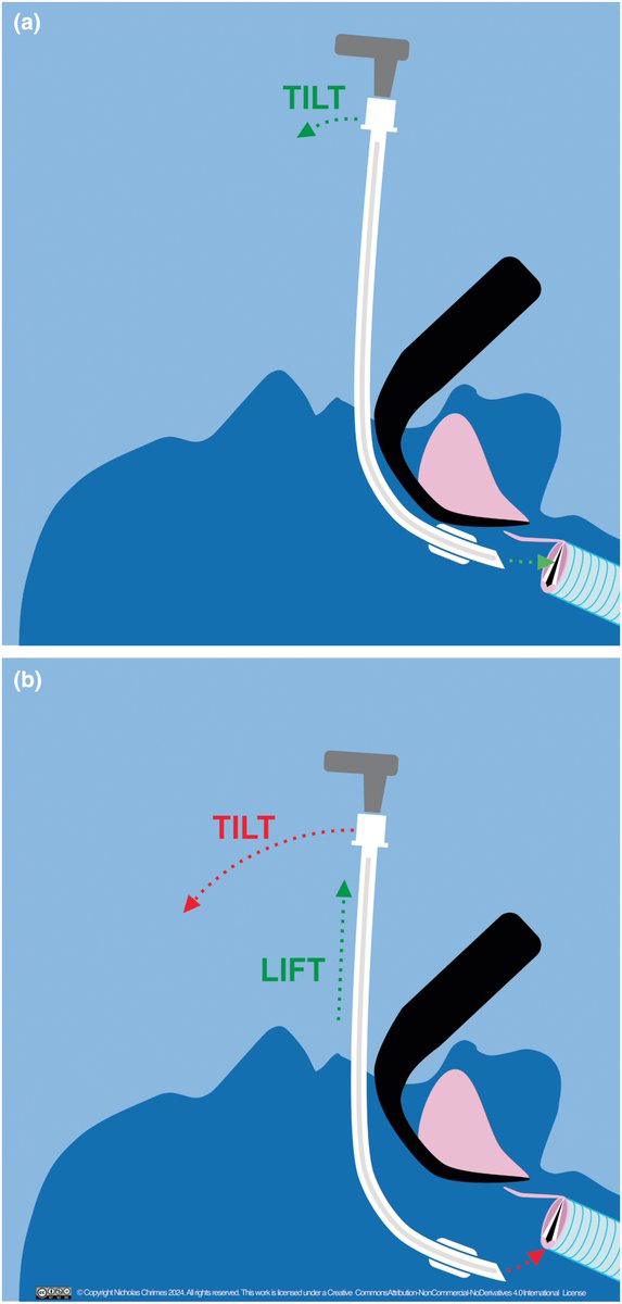 𝘈𝘯𝘢𝘦𝘴𝘵𝘩𝘦𝘴𝘪𝘢 (@anaes_journal) on Twitter photo What is the Cooper manoeuvre?
Vertical lifting of the tracheal tube until its tip is level with the glottis.
Avoid an exaggerated posterior tilt - this makes it more likely to ‘hang up’ on the arytenoid cartilages.
<a href="/NicholasChrimes/">Nicholas Chrimes</a>
🔗…-publications.onlinelibrary.wiley.com/doi/10.1111/an… What is the Cooper manoeuvre?
Vertical lifting of the tracheal tube until its tip is level with the glottis.
Avoid an exaggerated posterior tilt - this makes it more likely to ‘hang up’ on the arytenoid cartilages.
<a href="/NicholasChrimes/">Nicholas Chrimes</a>
🔗…-publications.onlinelibrary.wiley.com/doi/10.1111/an…
