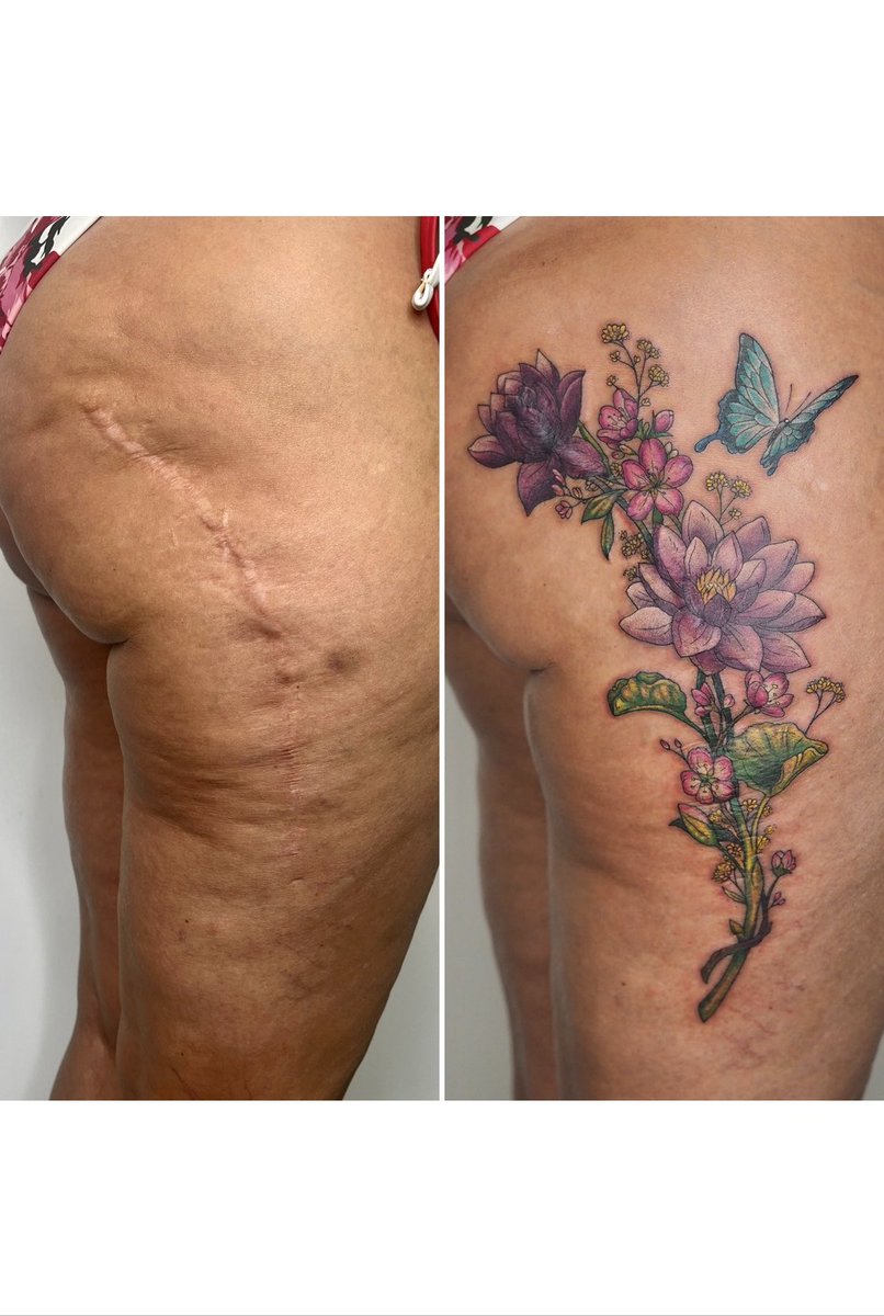 celestevtattoo's tweet photo. Hoy os traigo otro cover up de cicatrices! 🦋

En este caso, tras muchos años con una cicatriz por intervención quirúrgica, Carmen decidió dar este gran cambio y ponerse en mis manos.

Cover up con tatuaje con elementos significativos para ella :)

Espero que os guste mucho ✨ https://t.co/m1Ic51TCBe