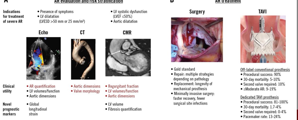 What’s new in aortic regurgitation and Transcatheter interventions? Read the review in <a href="/EuroInterventio/">EuroIntervention</a> 👉eurointervention.pcronline.com/article/aortic… @IcorCat <a href="/DFCapodanno/">Davide Capodanno</a> <a href="/hgermanstrias/">Hosp. Germans Trias</a> <a href="/elenadpelaez/">Elena Díaz Peláez</a> <a href="/EFerrerSistach/">Elena Ferrer Sistach</a>