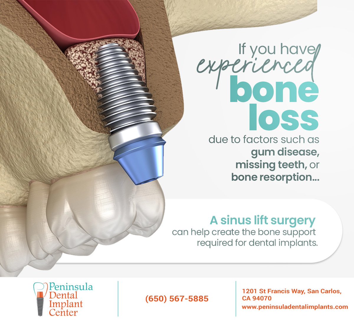 If you've been told you lack bone structure for dental implants, a sinus lift can change that. Book a consultation at Peninsula Dental Implant Center to learn more about sinus lift surgery. #sinuslift #dentalimplants #redwoodcity #CA #peninsuladentalimplants
