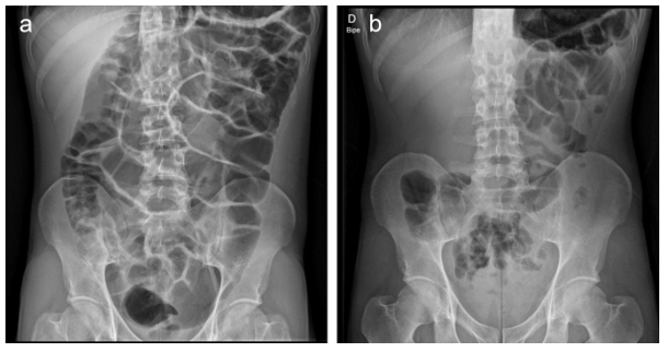 Sociedad Española de Patología Digestiva (SEPD) (@sepdigestiva) on Twitter photo 📖 Pseudoobstrucción intestinal crónica y cómo evitarla
<a href="/malageladac/">Carolina Malagelada</a> y Luis G. Alcalá-González destacan los errores más comunes y ofrecen consejos prácticos para evitarlos.
🔗 ueg.eu/a/355
<a href="/my_ueg/">my_UEG</a> <a href="/vallhebron/">Vall d'Hebron</a>
#gastroenterologia #saludigestivo 📖 Pseudoobstrucción intestinal crónica y cómo evitarla
<a href="/malageladac/">Carolina Malagelada</a> y Luis G. Alcalá-González destacan los errores más comunes y ofrecen consejos prácticos para evitarlos.
🔗 ueg.eu/a/355
<a href="/my_ueg/">my_UEG</a> <a href="/vallhebron/">Vall d'Hebron</a>
#gastroenterologia #saludigestivo