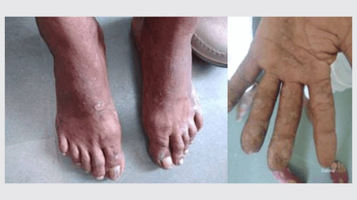 Role of individualized Homoeopathic Medicine in Allergic Dermatitis – A Case Report – Hpathy.com buff.ly/4cwuNwG