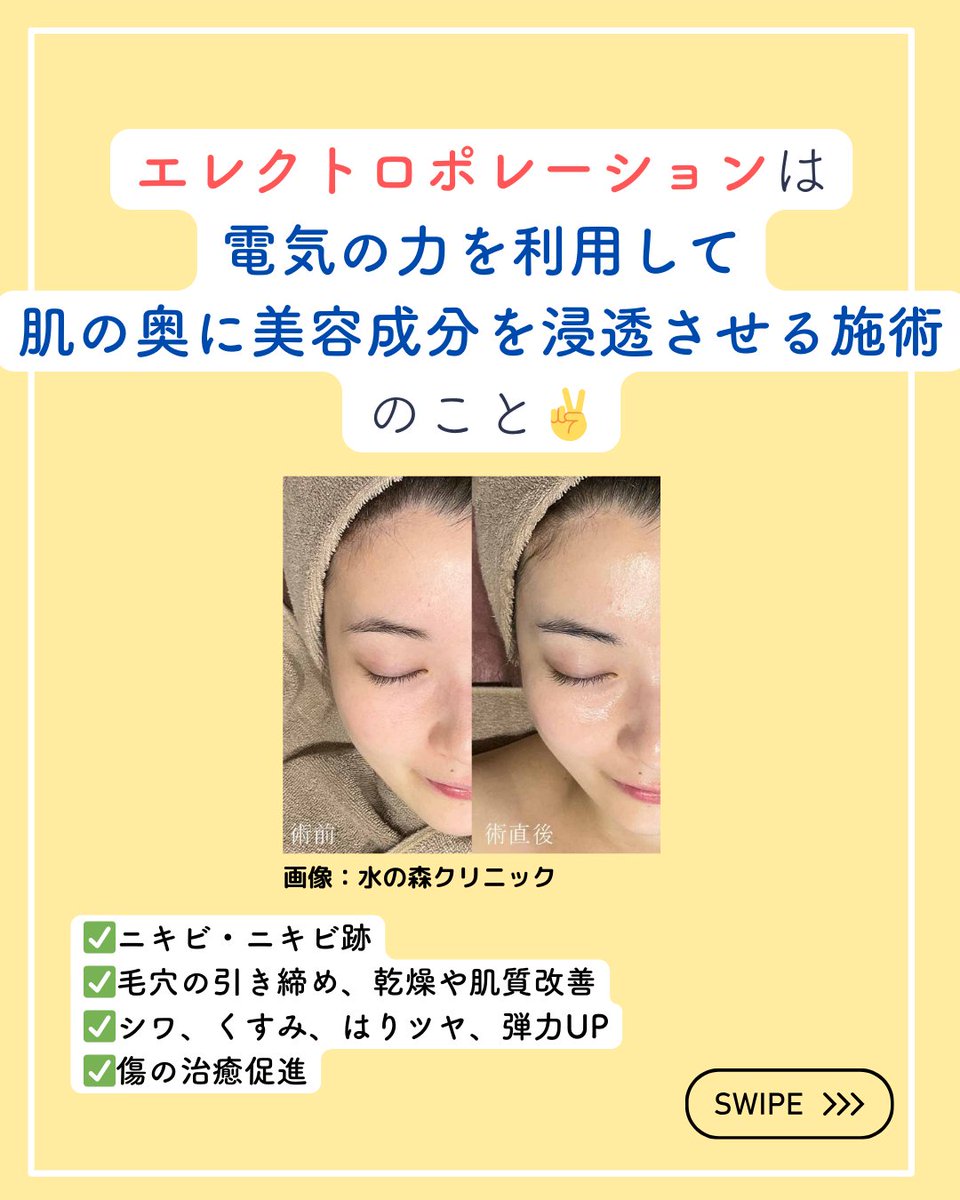 エレクトロポレーション VS LDM.✍️🔥／ ☑︎エレクトロポ