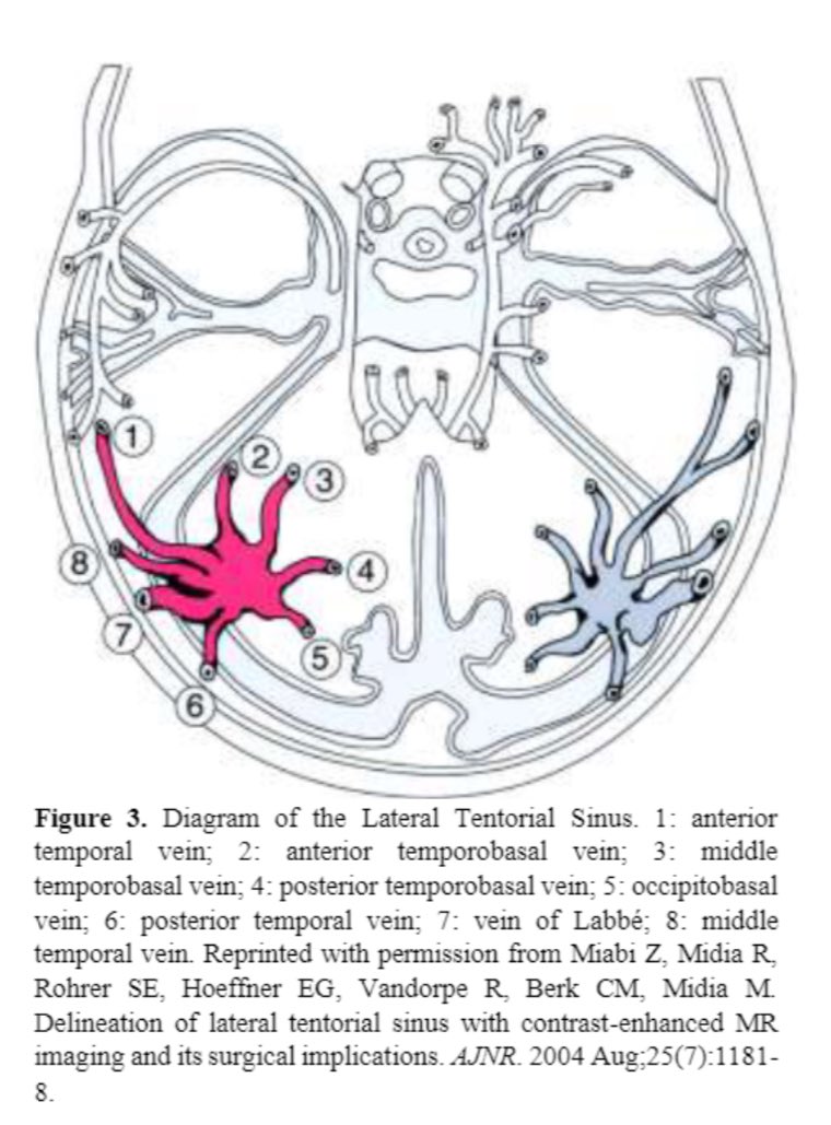 🌟 New Publication: Tentorial Sinus Thrombosis in a Patient with Sickle Cell Disease.

journals.psu.edu/strokeclinicia…

<a href="/AmreNouh/">Amre Nouh</a> <a href="/drkoriesh/">Ahmed Koriesh</a>