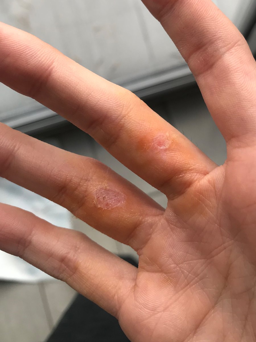 AlejandraIriza's tweet image. Hoy un pitbull atacó a mi perrito. La dueña lo tenía sin correa, por suerte lo soltó porque un chico me ayudó, pero lo lastimó. La dueña no se hizo cargo, no me acompañó a la veterinaria. Su excusa: el se crió con niños, es “bueno”. A mi también me mordió. El peor día de mi vida