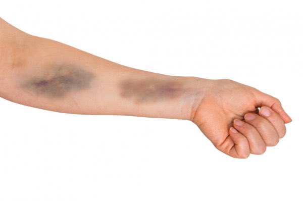 whoisNatts's tweet photo. @MasadBaby El brazo de masad viendo que no lo sueltan #Masad https://t.co/Ud3yfQB3Hv