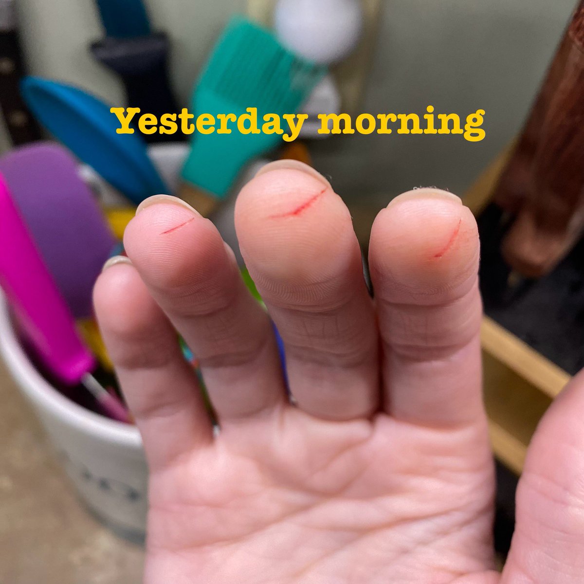 CarnivoreFriend's tweet photo. I did a 48 hour fast, 25 hours of which were a dry fast.

My fingers are healing up nicely! I think I should be able to sew tomorrow so I’m very excited!

#Carnivore #carnivorediet #fasting #healing #dryfast #extendedfast https://t.co/239cXdRCbM