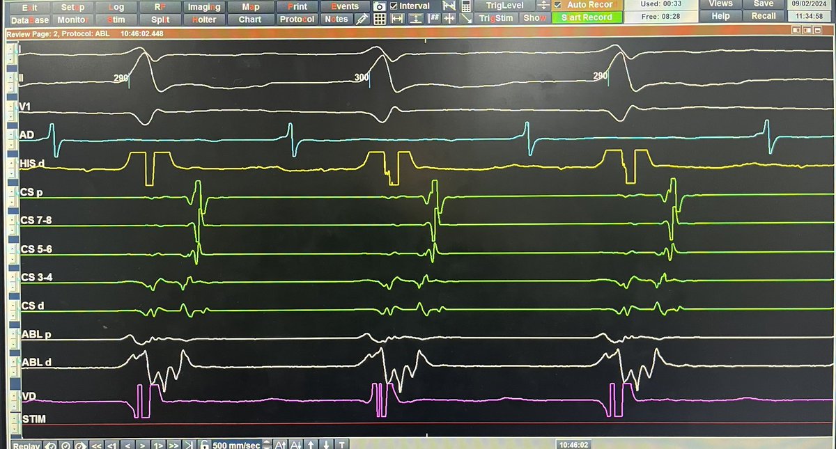 <a href="/syamkumarmd/">Syamkumar</a> <a href="/True_EP/">William H. Sauer, MD</a> <a href="/GusCostaEP57/">Gustavo Costa</a> It was a left posterior AP.
We practice the maneuver to be familiar with it and use it when appropriate.
It is always nice to practice maneuvers to  have confidence.