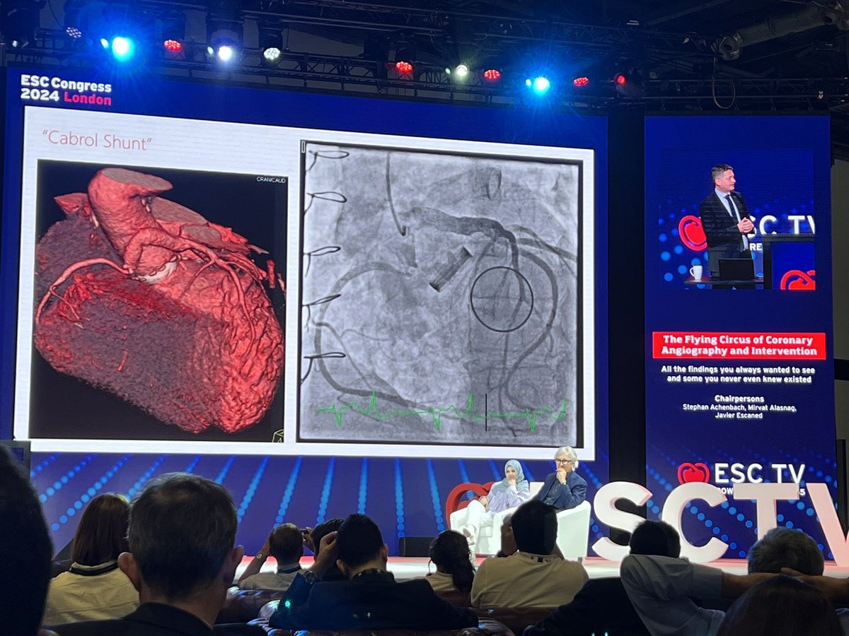 Joy Ong (@joyysong) on Twitter photo A Carbol Shunt can be inserted by surgeons to decompress/shunt blood from a perigraft space to the RA or venous system during aortic root surgeries with uncontrolled haemorrhage! #ESCTV #ESCCongress #FIT <a href="/escardio/">European Society of Cardiology</a> A Carbol Shunt can be inserted by surgeons to decompress/shunt blood from a perigraft space to the RA or venous system during aortic root surgeries with uncontrolled haemorrhage! #ESCTV #ESCCongress #FIT <a href="/escardio/">European Society of Cardiology</a>