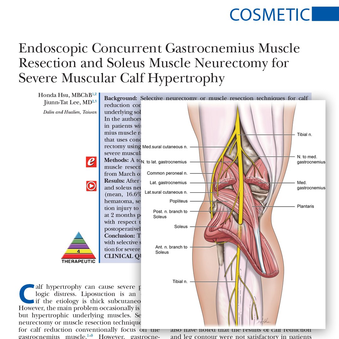 prsjournal's tweet photo. 🚨 New #CalfReduction breakthrough! Combining gastrocnemius resection with soleus #neurectomy via a single-incision, endoscope-assisted approach shows promising results for severe hypertrophy. 🌟💪 Curious? Click to learn more! 👉 https://t.co/FzeRtErt6U https://t.co/k7gwVyZD5g