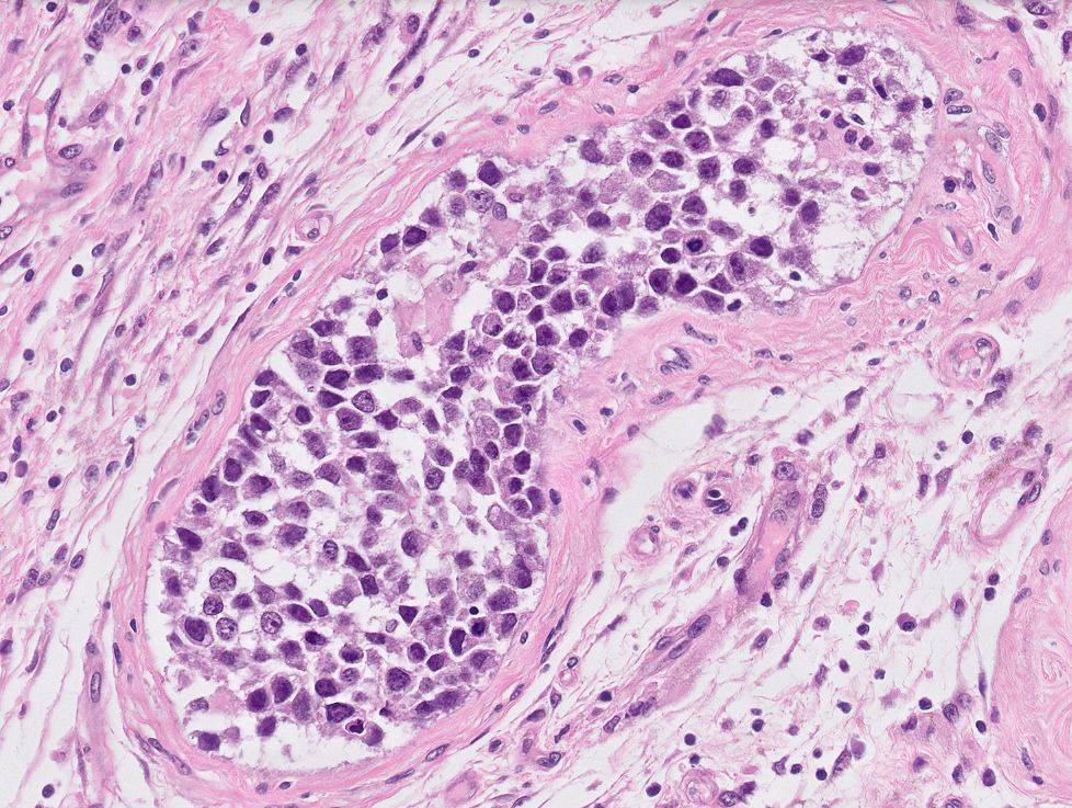 DrLaurenceGalea's tweet image. Intratubular seminoma and intratubular embryonal carcinoma in the same field

(From a radical orchidectomy specimen for mixed germ cell tumour)

#PathTwitter #Pathology #PathResidents #GUPath