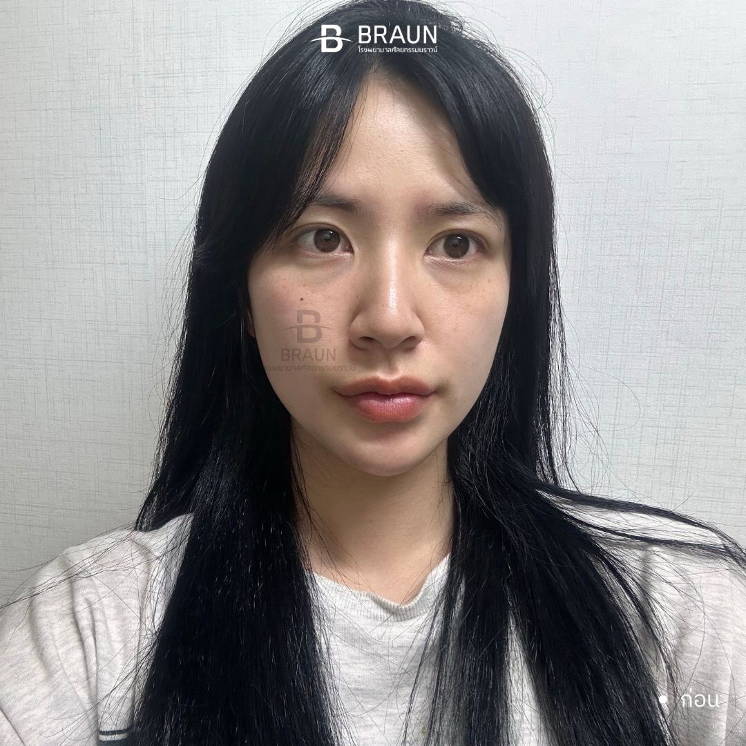 oppamethailand's tweet image. จมูกทรงที่ตามหา มาทางนี้ค่าาาา บราวน์ ผลงานคุณหมอรยูดงวานค่ะ❤️❤️❤️ 

📍 สวยฉ่ำแบบนี้ ทำอะไรบ้าง 
รายการศัลยกรรม

1. เสริมจมูก
+ สันไร้ซิลิโคน
+ แก้จมูกเอน
+ เหลาฮัมพ์
+ ตัดปีกจมูก
+ ยืดความยาวปลายจมูกด้วยกระดูกอ่อนซี่โครงบริจาค

#oppame  #ที่ปรึกษาศัลยกรรมเกาหลี #อันดับ1