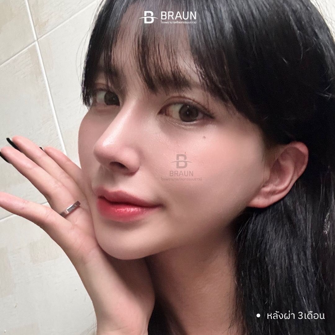 oppamethailand's tweet image. จมูกทรงที่ตามหา มาทางนี้ค่าาาา บราวน์ ผลงานคุณหมอรยูดงวานค่ะ❤️❤️❤️ 

📍 สวยฉ่ำแบบนี้ ทำอะไรบ้าง 
รายการศัลยกรรม

1. เสริมจมูก
+ สันไร้ซิลิโคน
+ แก้จมูกเอน
+ เหลาฮัมพ์
+ ตัดปีกจมูก
+ ยืดความยาวปลายจมูกด้วยกระดูกอ่อนซี่โครงบริจาค

#oppame  #ที่ปรึกษาศัลยกรรมเกาหลี #อันดับ1