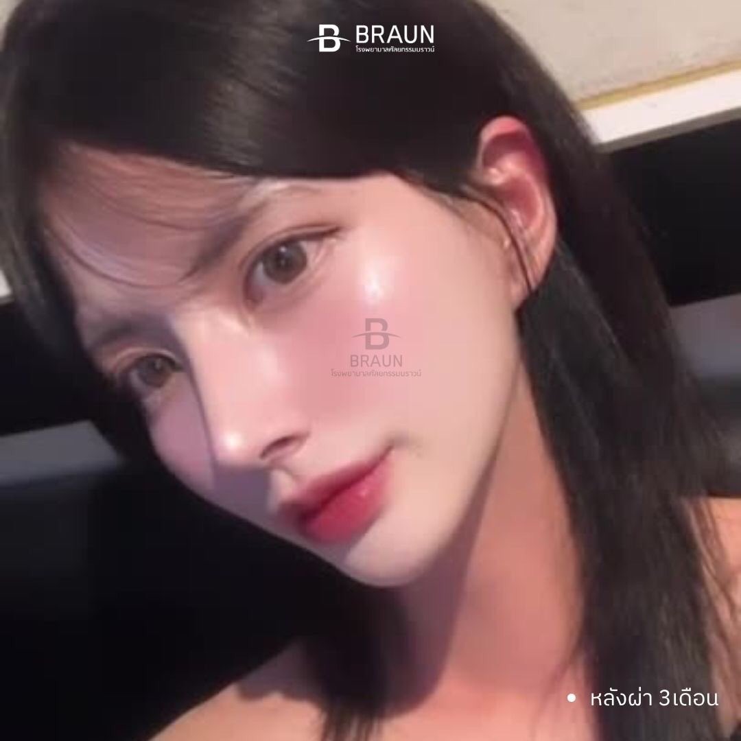 oppamethailand's tweet image. จมูกทรงที่ตามหา มาทางนี้ค่าาาา บราวน์ ผลงานคุณหมอรยูดงวานค่ะ❤️❤️❤️ 

📍 สวยฉ่ำแบบนี้ ทำอะไรบ้าง 
รายการศัลยกรรม

1. เสริมจมูก
+ สันไร้ซิลิโคน
+ แก้จมูกเอน
+ เหลาฮัมพ์
+ ตัดปีกจมูก
+ ยืดความยาวปลายจมูกด้วยกระดูกอ่อนซี่โครงบริจาค

#oppame  #ที่ปรึกษาศัลยกรรมเกาหลี #อันดับ1