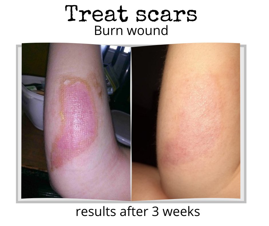 madebyrisch's tweet photo. 🌟 Say goodbye to scars and stretch marks with our Belly Paste! 🌟
Our Belly Paste is a game-changer for anyone dealing with stretch marks, scars, or uneven skin tone.
https://t.co/DId0qALpS3

#bellypaste #madebyrisch #scars #stretchmarks https://t.co/OzW2Kfzsb8