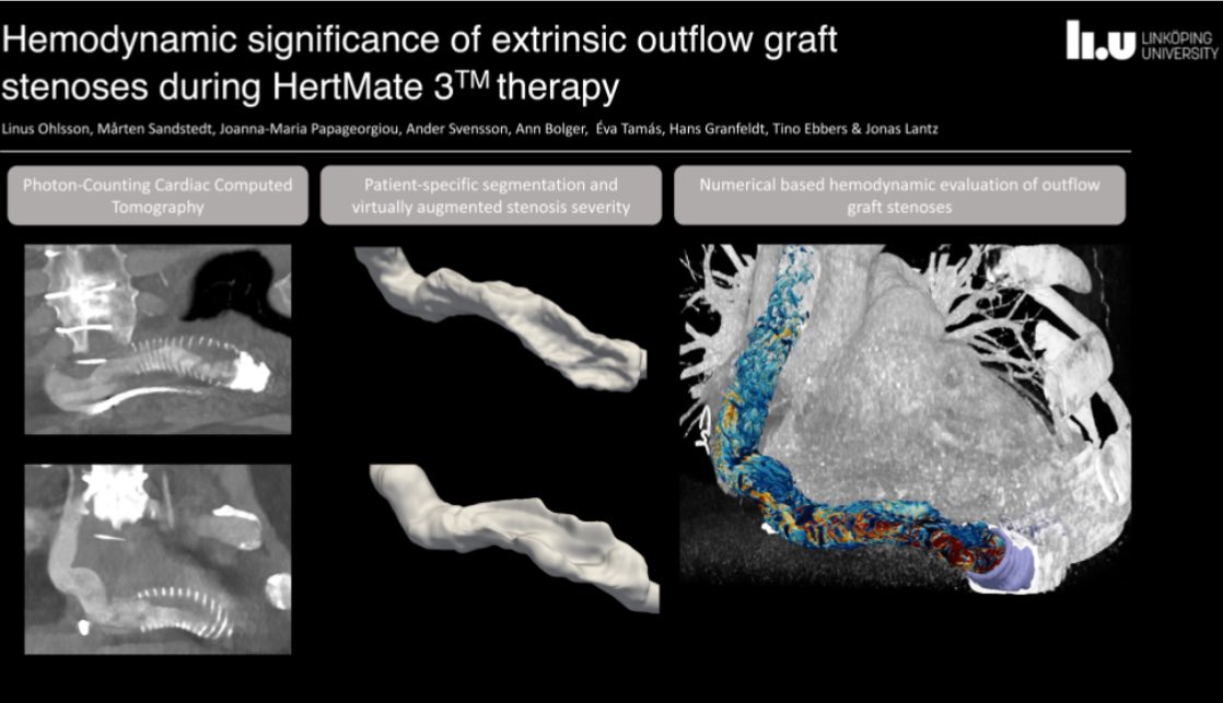 EHJ-IMP Editor-in-Chief (@ehjimpeic) on Twitter photo #EHJIMP Haemodynamic significance of extrinsic outflow graft stenoses during HeartMate 3⢠therapy <a href="/ESC_Journals/">European Society of Cardiology Journals</a> <a href="/escardio/">European Society of Cardiology</a> academic.oup.com/ehjimp/article⦠<a href="/alessia_gimelli/">Alessia Gimelli</a> <a href="/EZancanaroMD/">Edoardo Zancanaro MD</a> <a href="/ShehabAnwer/">Shehab Anwer, MD</a> <a href="/EACVIPresident/">EACVI President</a> <a href="/VDelgadoGarcia/">Victoria Delgado</a> <a href="/s_e_petersen/">Steffen Petersen</a> <a href="/AnastasiaSMihai/">Dr Anastasia Mihailidou FAHA FCSANZ FESC</a> <a href="/Hragy/">Hany Ragy</a> #EHJIMP Haemodynamic significance of extrinsic outflow graft stenoses during HeartMate 3⢠therapy <a href="/ESC_Journals/">European Society of Cardiology Journals</a> <a href="/escardio/">European Society of Cardiology</a> academic.oup.com/ehjimp/article⦠<a href="/alessia_gimelli/">Alessia Gimelli</a> <a href="/EZancanaroMD/">Edoardo Zancanaro MD</a> <a href="/ShehabAnwer/">Shehab Anwer, MD</a> <a href="/EACVIPresident/">EACVI President</a> <a href="/VDelgadoGarcia/">Victoria Delgado</a> <a href="/s_e_petersen/">Steffen Petersen</a> <a href="/AnastasiaSMihai/">Dr Anastasia Mihailidou FAHA FCSANZ FESC</a> <a href="/Hragy/">Hany Ragy</a>