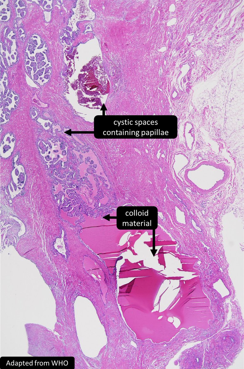 DrCycloPath's tweet photo. Bilateral ___ is a manifestation of von Hippel Lindau syndrome
A) papillary cystadenoma
B) juvenile granulosa cell tumor
C) microcystic stromal tumor
#GUPath #GynPath #PathTwitter #Pathology #PediPath https://t.co/igGCc87kPc