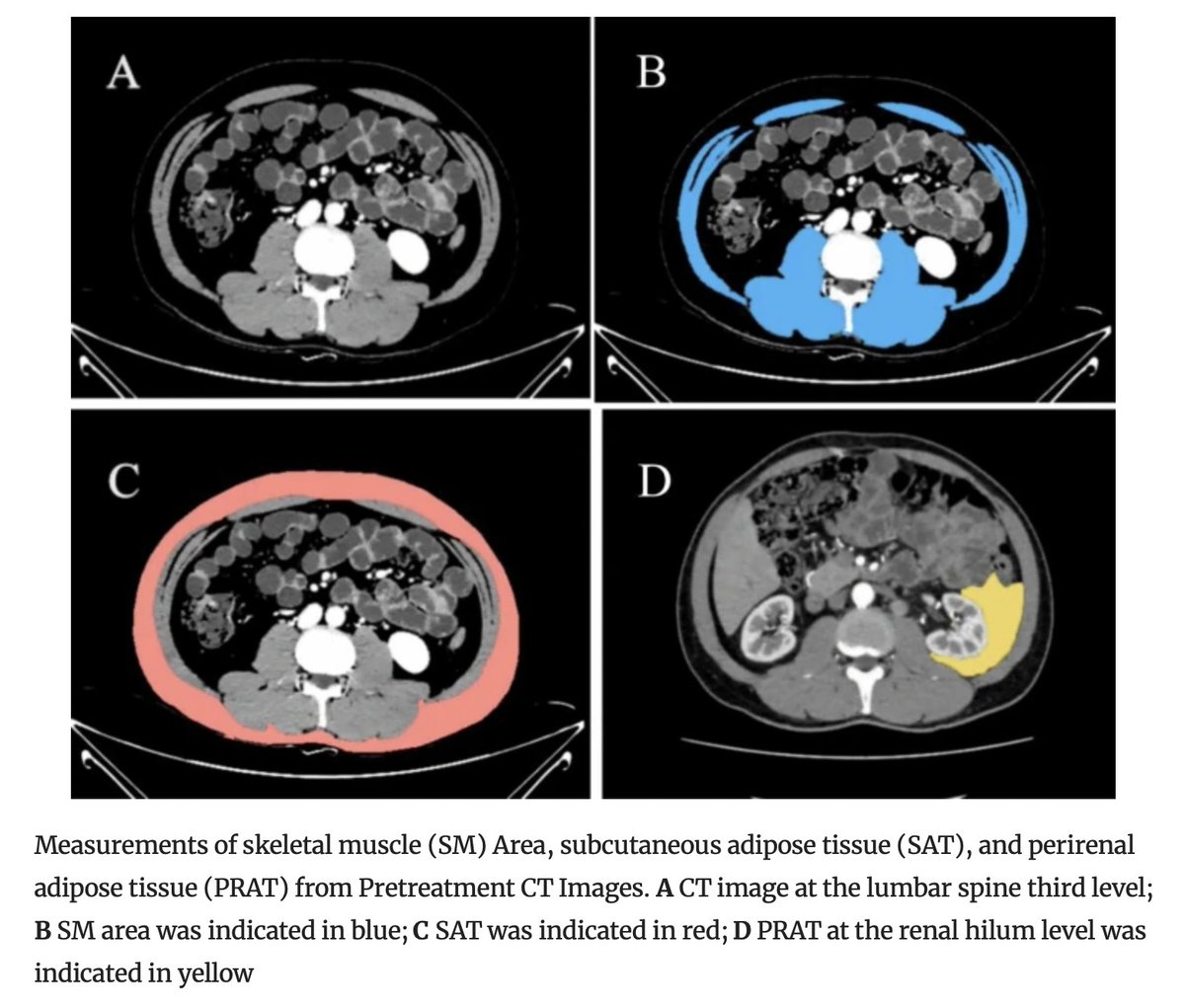 AnnSurgOncol's tweet image. September Issue: A Nomogram Including #Sarcopenia for Predicting Progression-Free Survival in Patients with Localized Papillary #RenalCellCarcinoma : A Retrospective Cohort Study

rdcu.be/dSvl6

@SyedAAhmad5