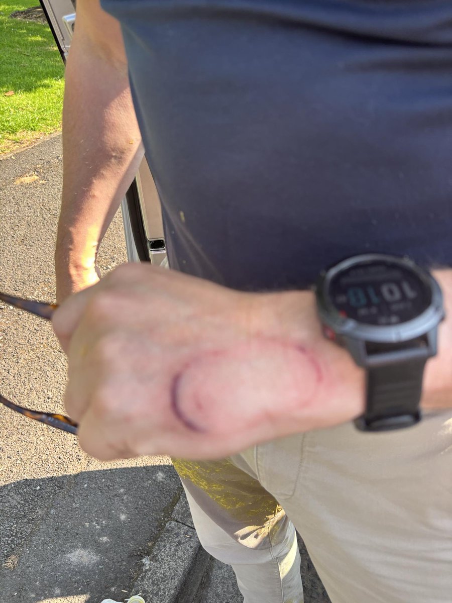 MrsJJill's tweet image. @marksandspencer worrying to think that an exploding orange juice bottle that causes injuries like this isn’t classed as a safety concern. Pleased it wasn’t a child opening this bottle! #poorresponse