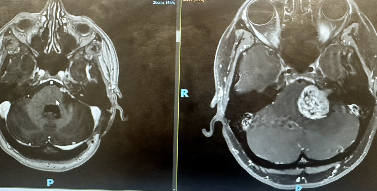 Dr Amir R. Dehdashti (@amirdehdashti) on Twitter photo Near total resection(>95-98%) of large #vestibular #schwannoma as we published few years ago by Schneider J et al. <a href="/NeurosurgeryCNS/">Neurosurgery Publications</a> results in excellent long term facial nerve function( HB grade I-II), >90% of patients w tiny remnants do not need additional tx and remain stable. Near total resection(>95-98%) of large #vestibular #schwannoma as we published few years ago by Schneider J et al. <a href="/NeurosurgeryCNS/">Neurosurgery Publications</a> results in excellent long term facial nerve function( HB grade I-II), >90% of patients w tiny remnants do not need additional tx and remain stable.