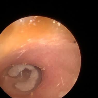 Today’s patient visited our  clinic for a pre health ear check. Can you guess what this shows?

Visit us at 

earhealthclinic.org.uk