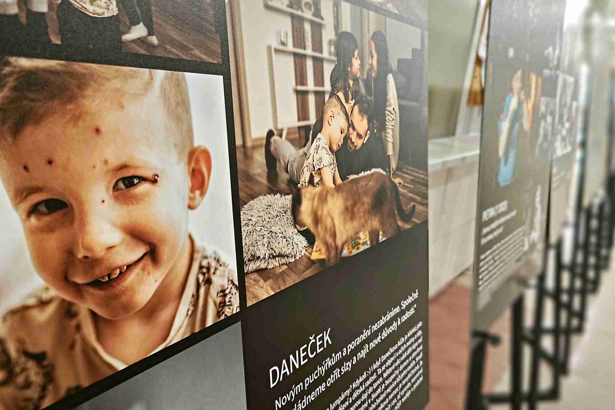 fnolomouc's tweet photo. Mají kůži křehkou jako motýlí křídla, ale vlídný dotek jim neublíží. V monobloku se zastavte u příběhů lidí s nemocí motýlích křídel, putovní výstavy @cr_debra. https://t.co/FQDcPRxkSw https://t.co/yWuoD9hH6B