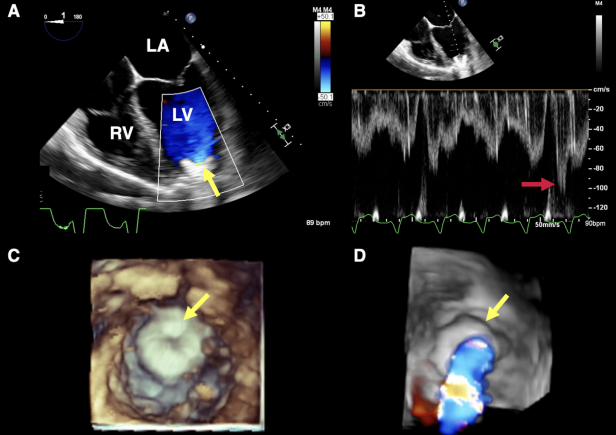 🫀NEW GUIDELINE🫀 bit.ly/3X9yjaM
We have just released "Recommendations for Multimodality Imaging of Patients With Left Ventricular Assist Devices and Temporary Mechanical Support: Updated Recommendations from the American Society of Echocardiography."

#ASEGuidelines